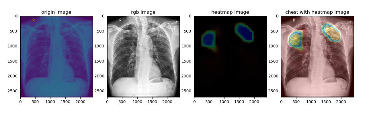 _images/chest_with_heatmap.png